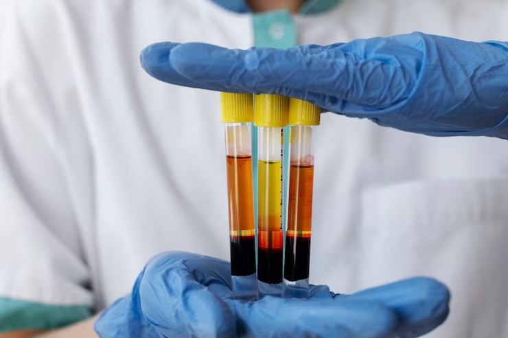 gejala gagal ginjal, silent disease ginjal, tes darah ginjal, tes urine ginjal, USG abdomen ginjal, deteksi dini penyakit ginjal, cek ginjal usia 30, kesehatan ginjal ibu muda